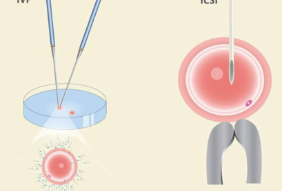 Untitled design (3) IVF VS ICSI