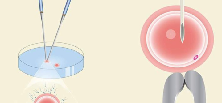 Untitled design (3) IVF VS ICSI