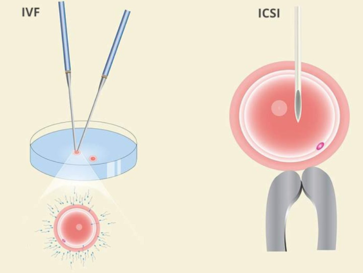 IVF VS ICSI