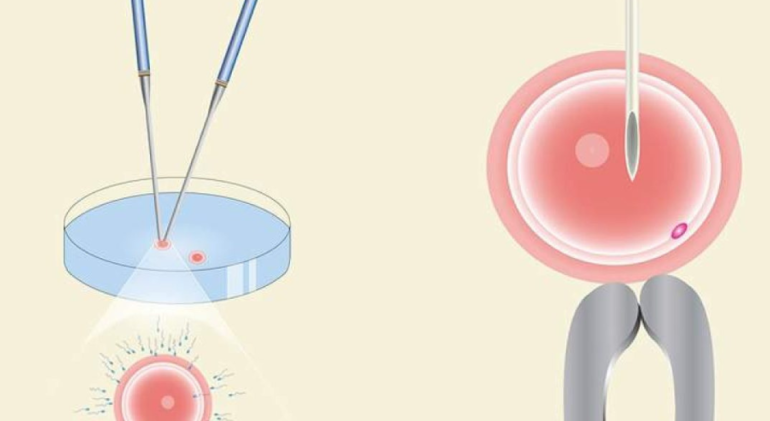 IVF VS ICSI