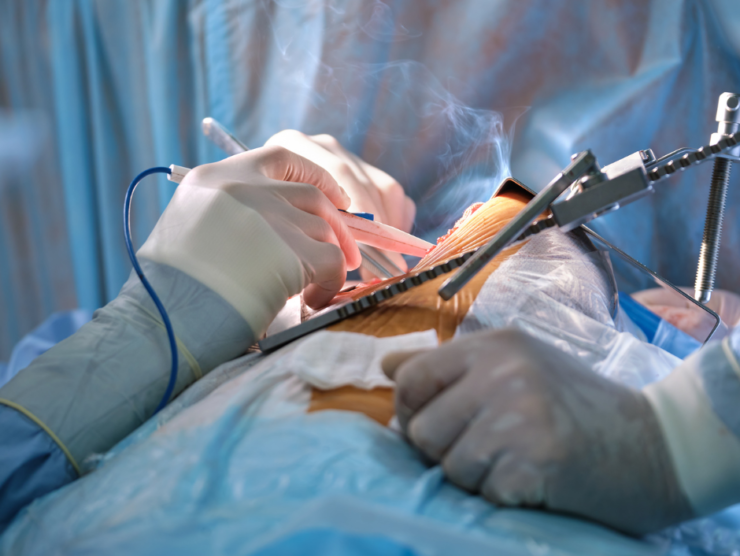 RECOVERY AFTER MICRO-TESE SURGERY: WHAT PATIENTS SHOULD EXPECT