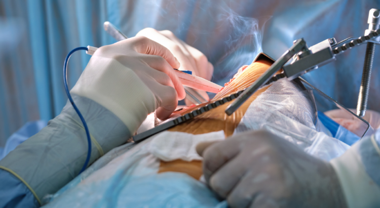 RECOVERY AFTER MICRO-TESE SURGERY: WHAT PATIENTS SHOULD EXPECT